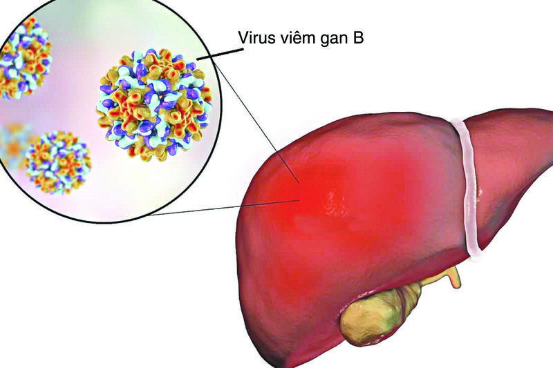 Viêm Gan B - Bệnh Truyền Nhiễm Phổ Biến Và Nguy Hiểm Nhất Hiện Nay